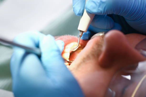 Urgent Tooth Repair in LA