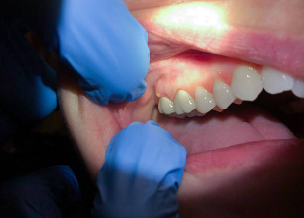Best Teeth Whitening  in Jean Fitte, LA
