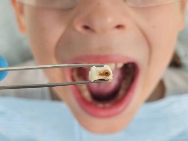 Best Dentist for Tooth Abscess  in Jean Fitte, LA
