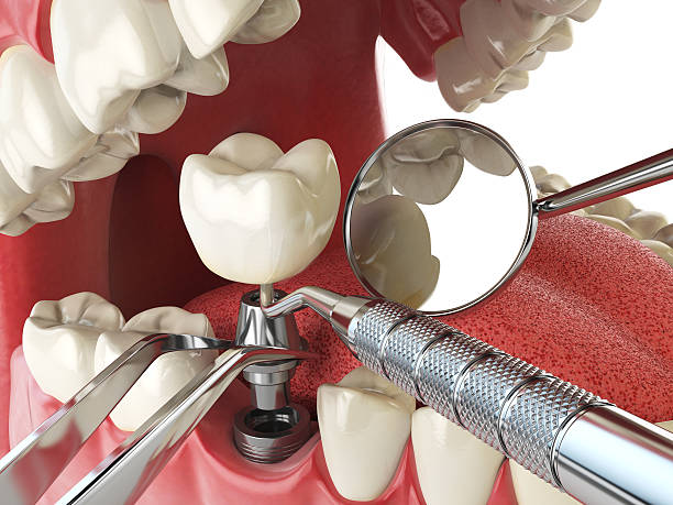 Emergency Dental Filling Replacement in LA